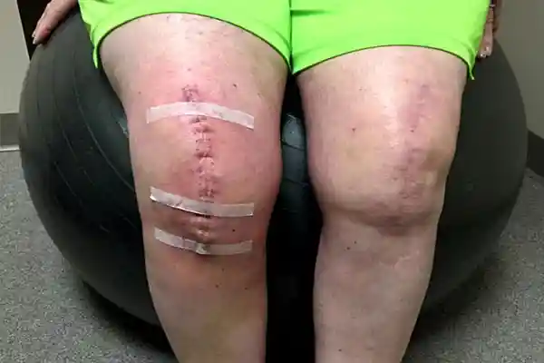 Post Surgical Rehabilitation